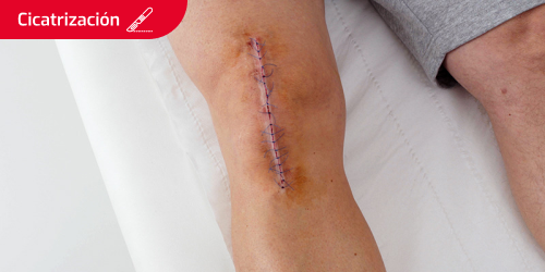 Imagen de una rodilla con una cicatriz Imagen de una rodilla con una cicatriz